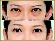 Enchimentos cutâneos faciais ácidos hialurónicos para o círculo de enchimento do olho da calha do rasgo