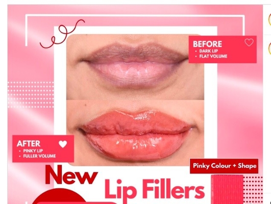 HYDROIAM Kiss com B12 Ha Filler Red Lips Filler Hyaluronic Acid Filler Fornece volume e cor naturais