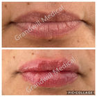 Injecções de ácido hialurónico nos lábios Preenchimentos de lábios de aparência natural Não cirúrgicos