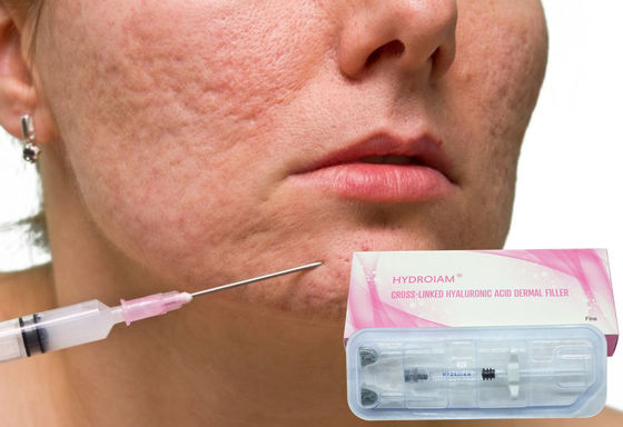 injeção do gel de Hyaluronate do sódio 1ml para remover os enrugamentos faciais finos