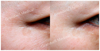 Cuidados com a pele cutâneos do enchimento da face lift PCL que levantam apertando o colagênio de estimulação