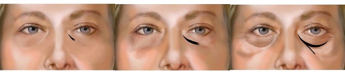 a solução ácida hialurónica injetável de 1ml 2ml remove o tratamento escuro dos círculos dos olhos