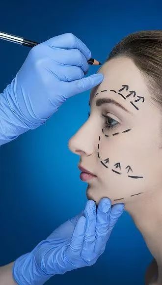 As rugas suaves e a linha da mandíbula definida com enchimentos faciais 70% HA cruzado ligado 24 mg 30% calcio hidroxilapatita