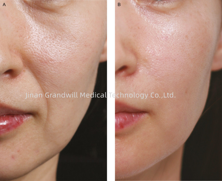 Miracle H L PCL Skin Booster Linha fina Policaprolactona Filler para injecção de ácido hialurónico