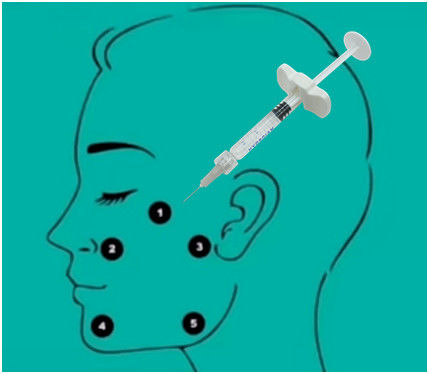 gel ácido hialurónico ácido hialurónico ligado cruz do enchimento de 32mg H-HA L-HA não