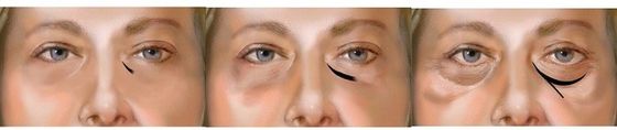 a solução ácida hialurónica injetável de 1ml 2ml remove o tratamento escuro dos círculos dos olhos
