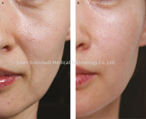enchimento cutâneo de Hyaluronate do sódio de 1ml HA Polycaprolactone branco