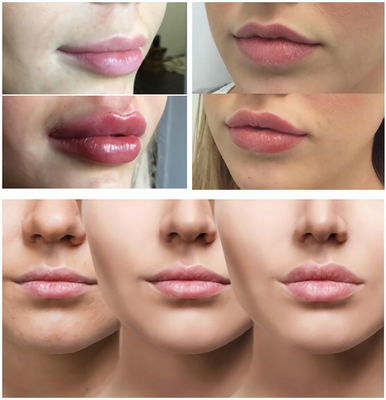 Hyaluronic Acid Filler Injectação de rugas HA Face Breast Butt Filler Injectação