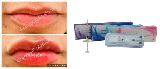 Enchimento cutâneo ácido hialurónico ligado transversal da injeção do sódio para enrugamentos faciais da plenitude do bordo