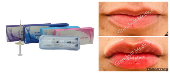 5 ml de enchimento labial Ácido hialurónico Gel de injecção Enchimento de frasco Seringa Embalagem Tratamentos de rugas faciais