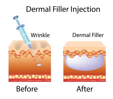 Fabricante de Enchimento de Ácido Hialurónico Gel Injetável Modificado de Hyaluronato de Sódio para Rosto e Corpo