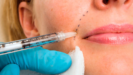 50 ml de Enchimento Dermológico Facial do Chin com Ácido Hyalurónico Injetável e Lidocaína PCL Plla Filler Injeção