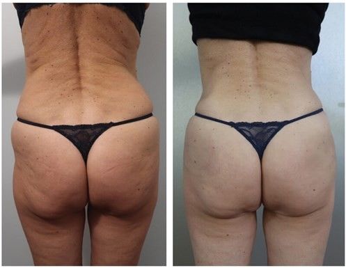 Preço Barato 50ml Filler para o Corpo Ácido Hialurónico Gel Injetável Garrafa Embalagem Aumento da mama Aumento da nádega