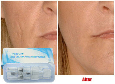 Enchimento injetável ácido hialurónico 10ml para mordentes Chin Augmentation da injeção do bordo
