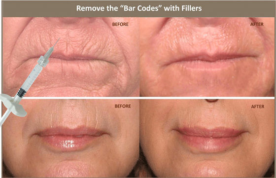 enchimento 10ml cutâneo ácido hialurónico injetável para corrigir a assimetria facial