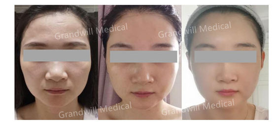 Preenchedor dérmico de ácido hialurônico estéril, reticulado, projetado para contorno facial com aparência natural e rejuvenescimento da pele