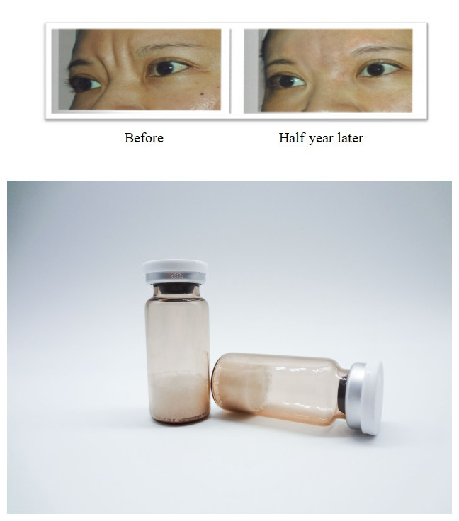 Gel injetável não animal para preenchimentos cutâneos faciais à base de ácido hialurónico para tratamento seguro de rugas e restauração do volume